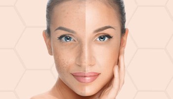 Пигментные пятна. Современные возможности коррекции