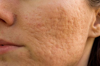 Гипрекератоз на коже лица